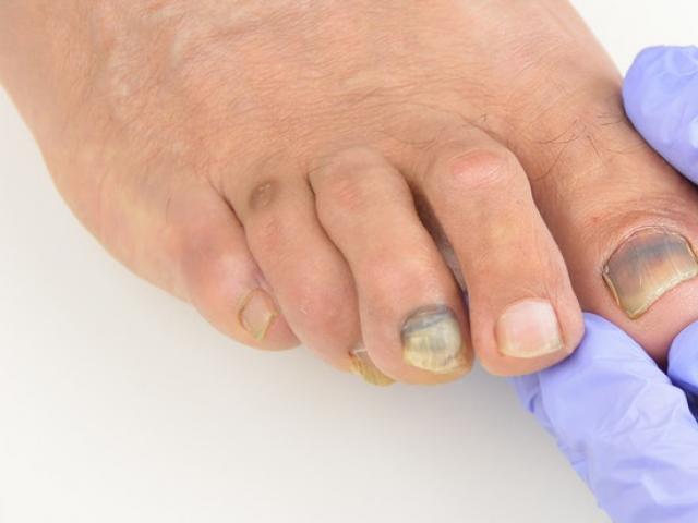 爪の近くの指の膿瘍：薬で治療する方法