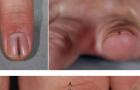 爪黒色腫の写真 爪下黒色腫の段階
