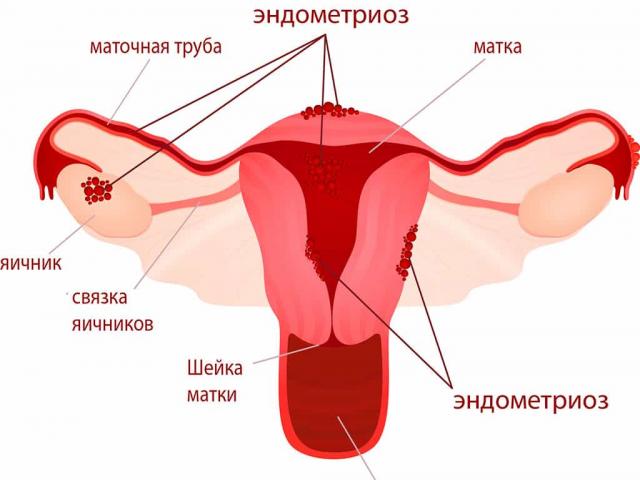Pse barku i poshtëm tërheq dhe dhemb pas menstruacioneve: arsyet kryesore