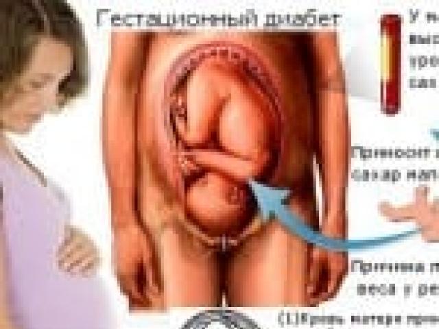 Gratë shtatzëna Rhodework me diabet me diabet gestational bëjnë seksionin cezarian