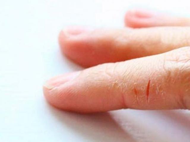 皮膚のひび割れ：原因と治療法